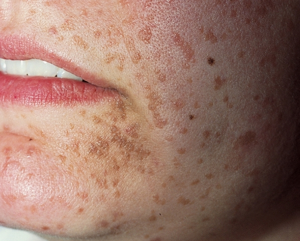 Virusul papiloma pe față, Tot ce trebuie sa stii despre HPV: Simptome & Tratament