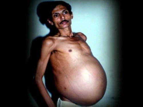 Barbatul gravid